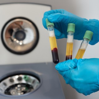 Mit jelent a trombocitaszám érték a laborleleten? című cikk nyitóképe