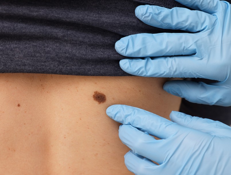 agresszív melanoma bőrrák tünete jele felismerése