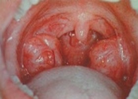 Hogyan működik a mandulánk?