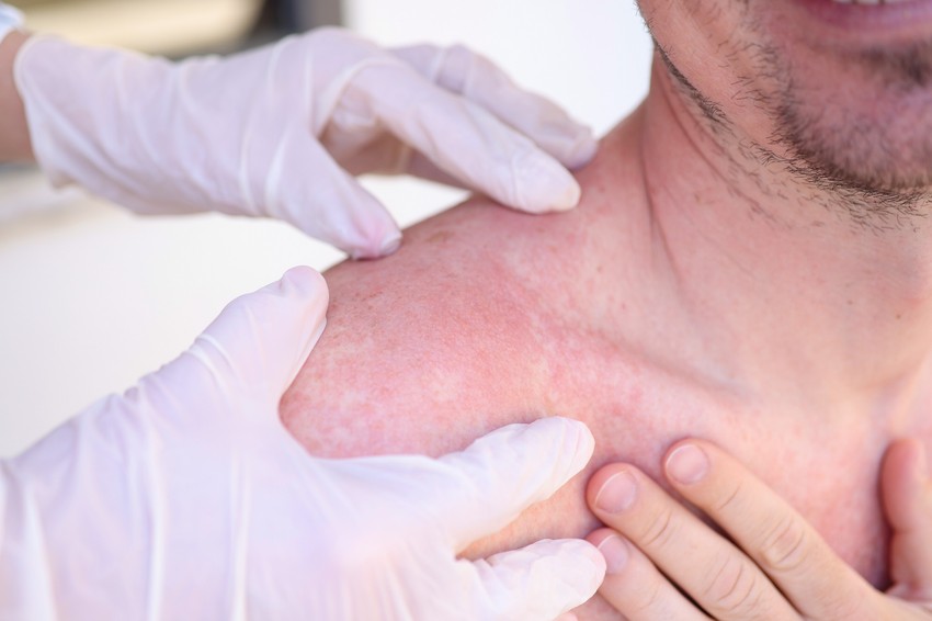 A napallergia pontos kiváltó oka még nem ismert, azonban a hajlamosító tényezők mellett a kialakulásában az UV-A és UV-B sugaraknak egyaránt szerepe lehet.