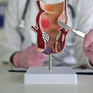 Divertikulum (béltágulat): tüntei, vizsgálata és kezelési lehetőségei című cikk nyitóképe