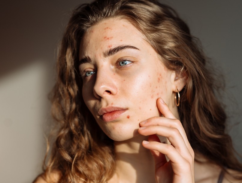 felnőttkori akné pattanás napsütés nyár