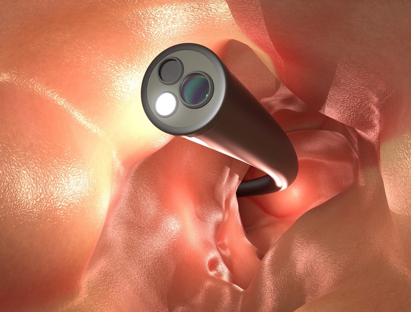 kolonoszkópia előkészület vastagbéltükrözés előtt étkezés ételek