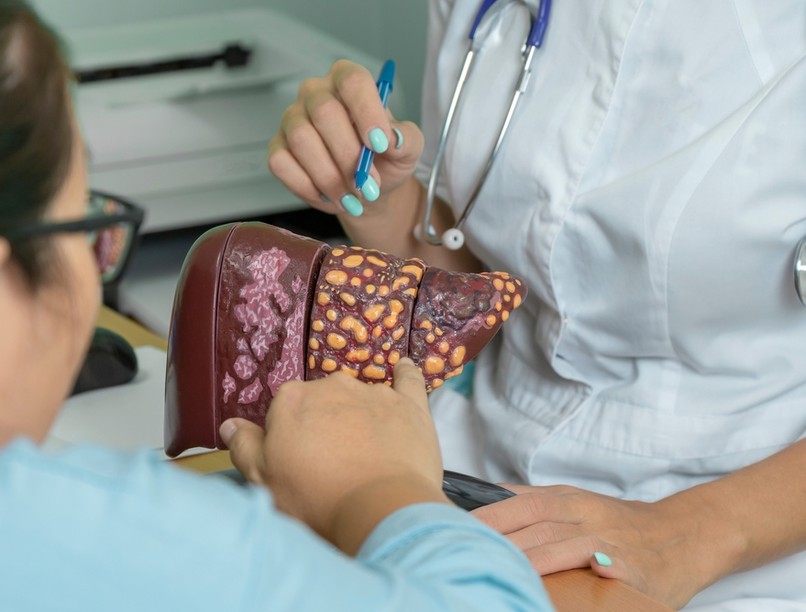 májzsugorodás, májcirrózis, végstádium, gyulladás, májkárosodás,