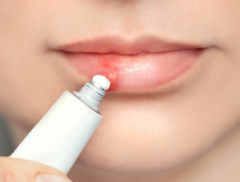 mi jó herpeszre házilag természetes gyógymód, házi módszer ajakherpesz ellen