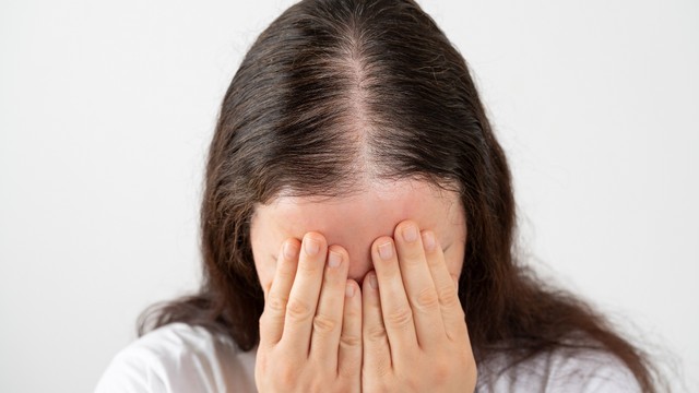 Hajhullás és kopaszodás nőknél: ezt teheti ellene