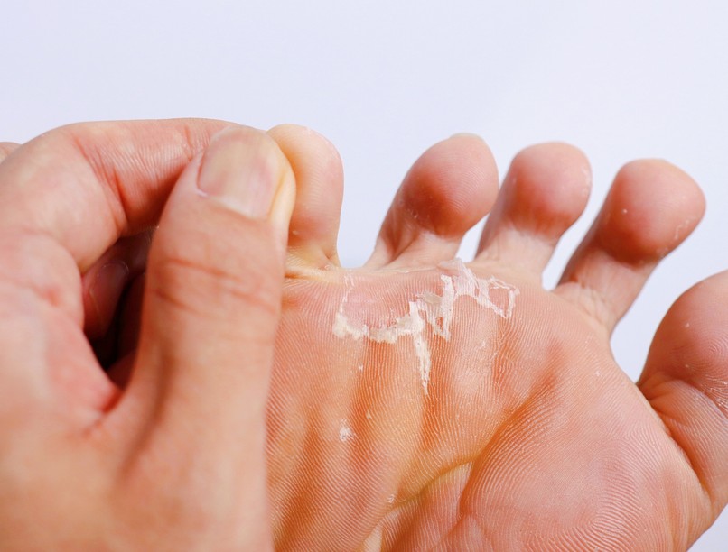 fehér felázott bőr bőrgomba lábgomba típus, tünet kezelés