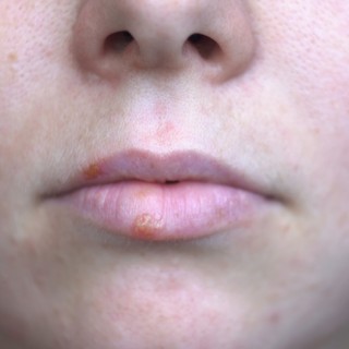 A herpesz két arca: így kapcsolódik az ajakherpesz és a genitális herpesz című cikk nyitóképe