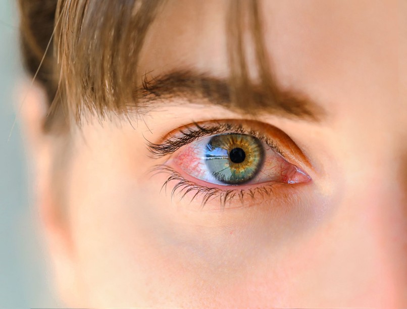 kötőhártya-gyulladás lappangási idő