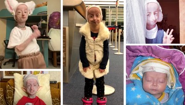 Anja Dobbie: így él egy extra gyorsan öregedő lány