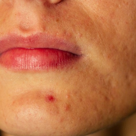 Mit jelez a szervezet az állon megjelenő pattanással? Nem mindig csak bőrprobléma című cikk nyitóképe