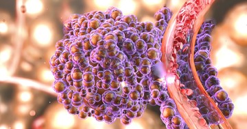  Miért újulhat ki a rák? Az onkológus szerint ezek a fő okok 