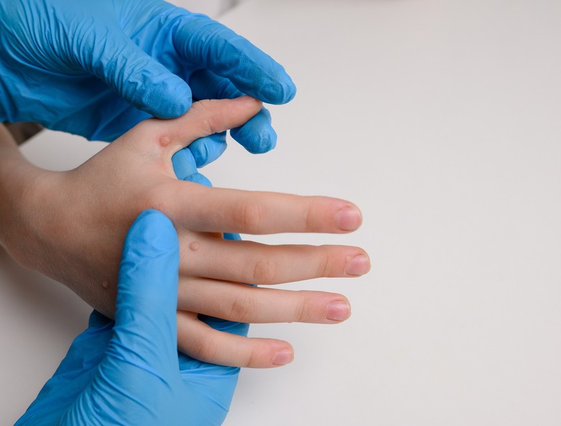 szemölcs ellen lézeres kezelés