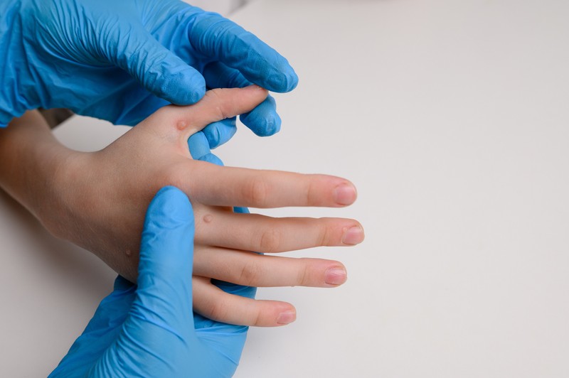 Szemölcseltávolítás lézerrel – fontos tudnivalók, mielőtt belevágna