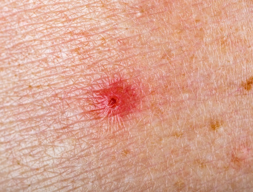 anyajegy melanóma tünetei figyelmezetető jele