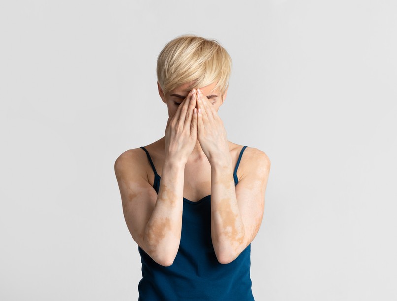 Mit tehetünk a pigmentfoltok, a hiperpigmentáció ellen?