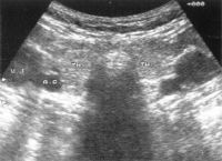 Pajzsmirigybetegségek: a göbös golyva