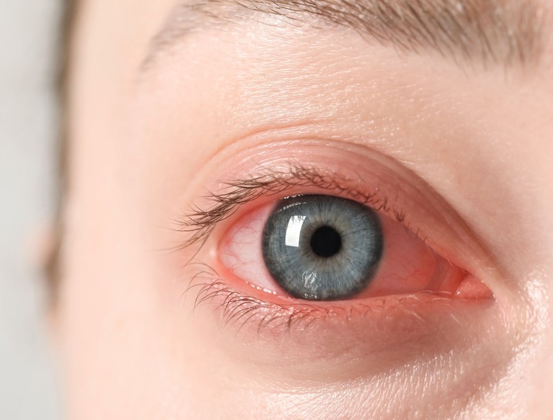 Kötőhártya gyulladás esetén leggyorsabb legjobb gyógyulás