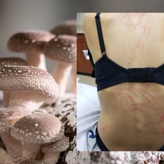 Mintha megkorbácsolták volna: furcsa kiütések jelentek meg egy nő hátán miután shiitake gombát evett című cikk nyitóképe