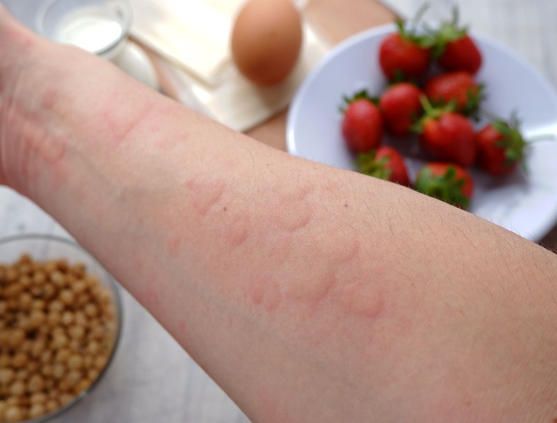 Ezek az ételek okoznak leggyakrabban ételallergiát