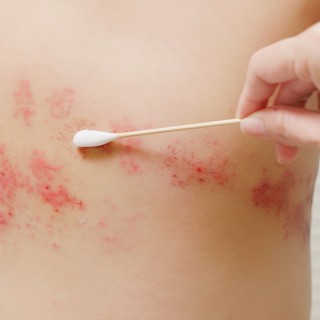 Lappang majd egyszer csak belobban! Ilyen kiütésekkel, hosszan tartó idegfájdalommal járhat az övsömör című cikk nyitóképe