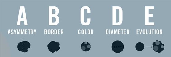 Melanoma: így ismerjük fel a bőrrák jeleit