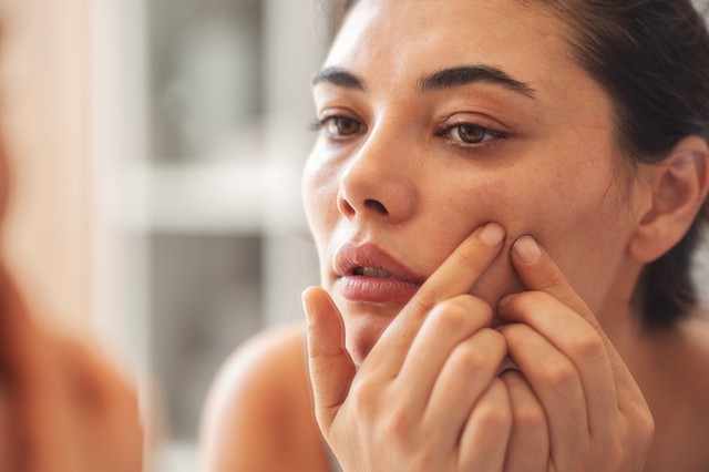 Mitesszeres a bőre? Ezeket a praktikákat próbálja ki otthon!
