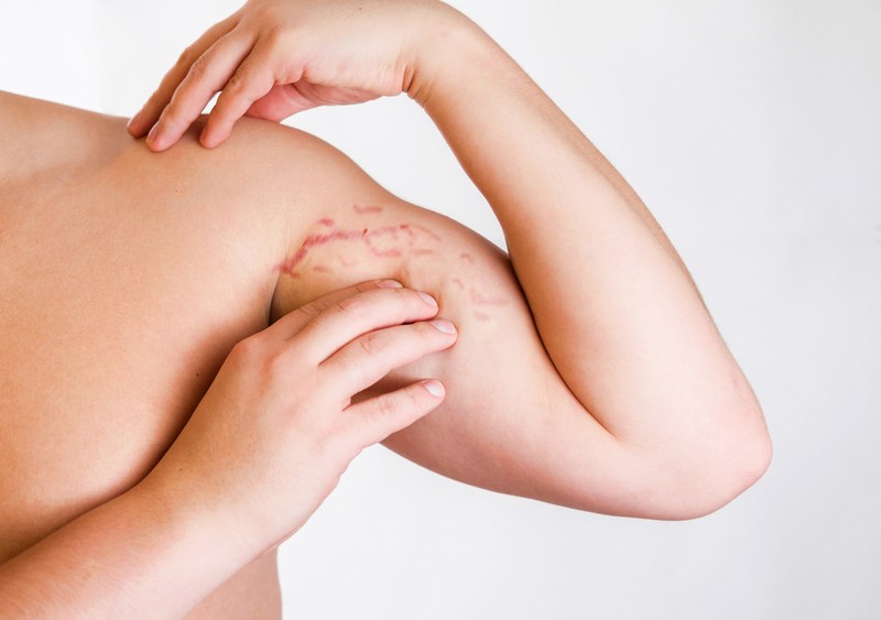 Ezt lehet tenni a striák ellen!