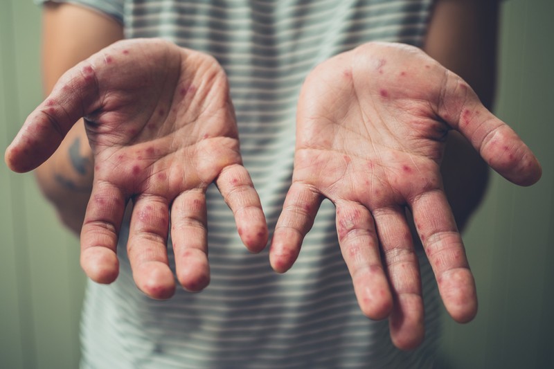 Honnan tudhatom meg, hogy a 37 éves lányom volt-e bárányhimlős? Az orvos válaszol