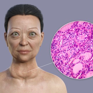 Basedow-kór: tünetei, vizsgálata és kezelési lehetőségei című cikk nyitóképe