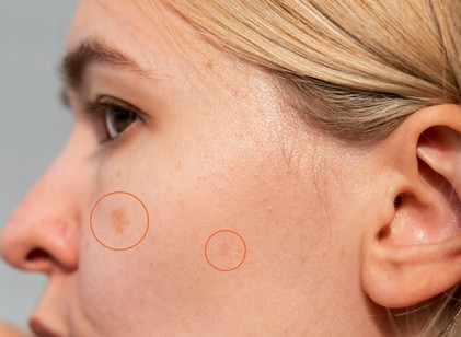 Miért jelenhetnek meg idő előtt az öregségi foltok, és mit kezdhetünk velük? című cikk nyitóképe