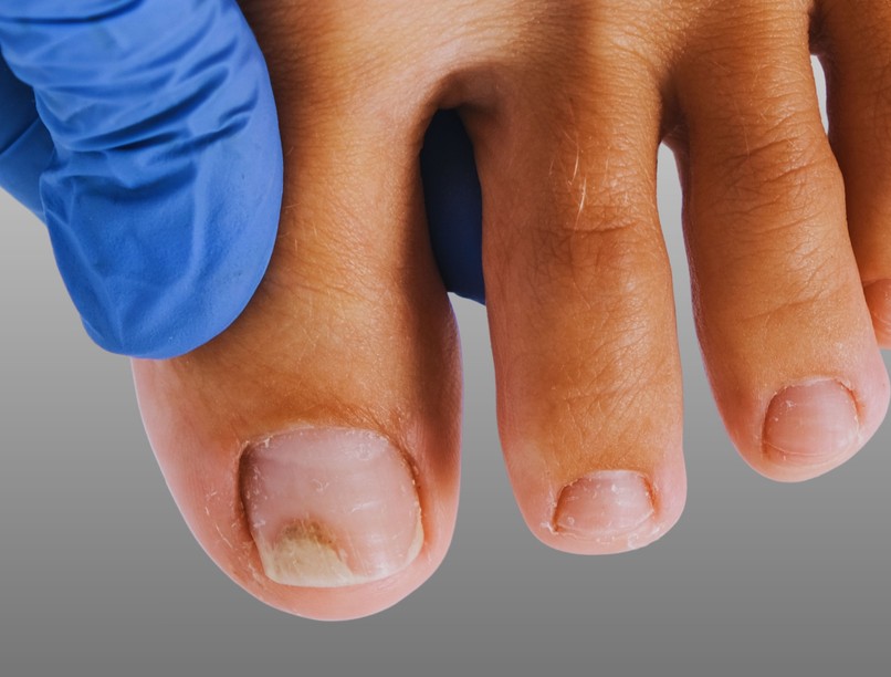 köröm sárga leválik gomba pikkelysömör