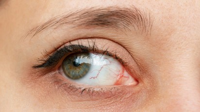 Szifilisz: a szemen is megmutatkozhatnak a fertőzés tünetei című cikk nyitóképe