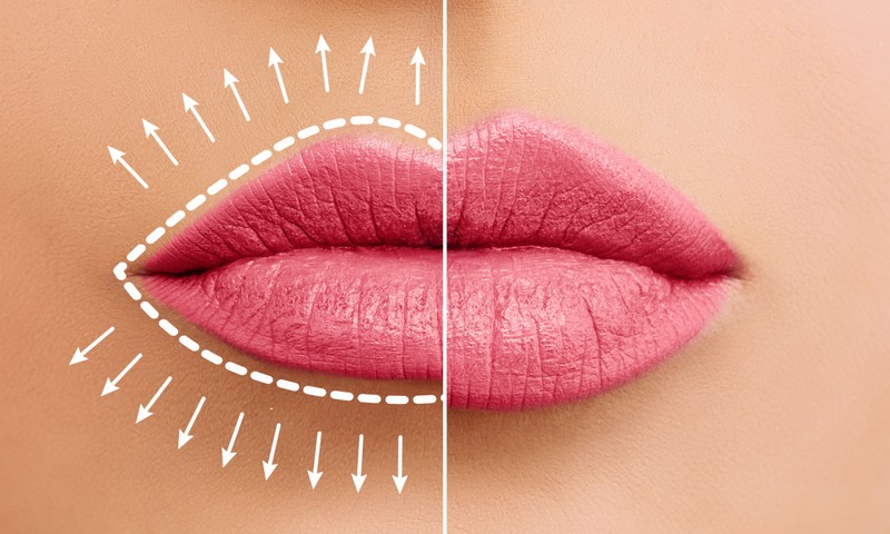 Itt vannak az eredmények: így gondolkodnak az emberek az ajakfeltöltésről