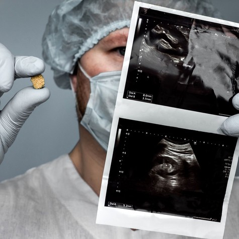 Mitől alakul ki a vesekő? Ez az, amit a háttérben zajló folyamatokról tudnia érdemes című cikk nyitóképe