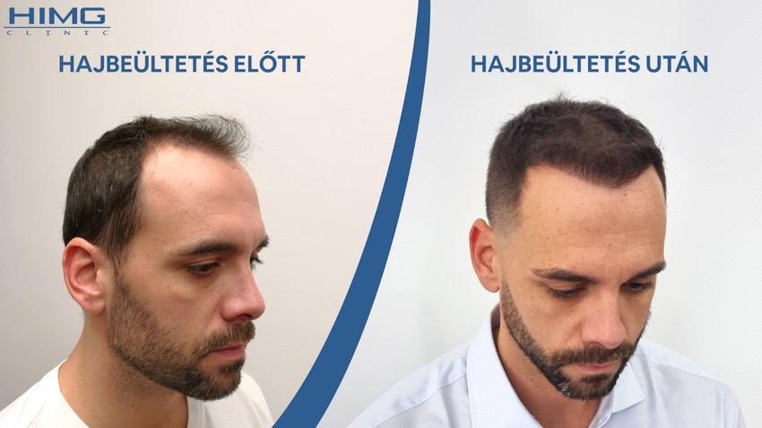 Mikor lesz látható a végleges eredmény a hajbeültetés után?