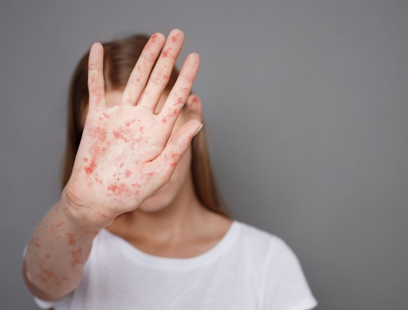 kanyaró, európa, hírek, oltás