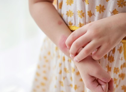 Ekcémás bőr gyermekeknél: hogyan ápolja helyesen, és miként csökkentheti a fellángolás gyakoriságát? Ez az orvos válasza című cikk nyitóképe