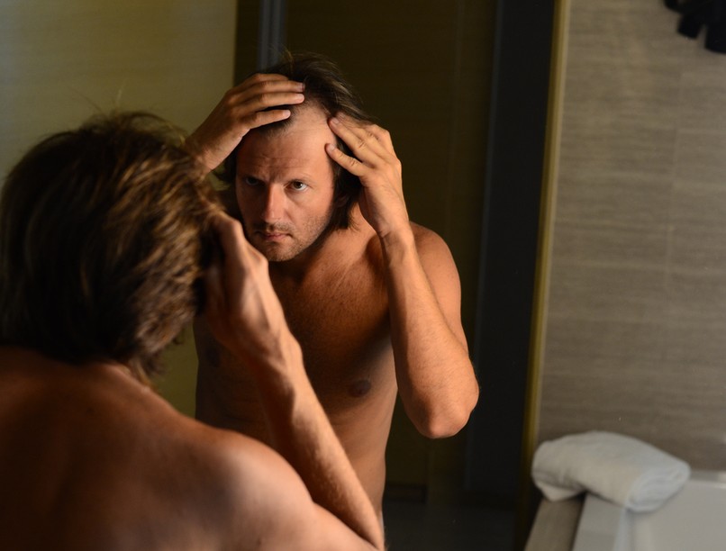 kopaszodás, hajhullás