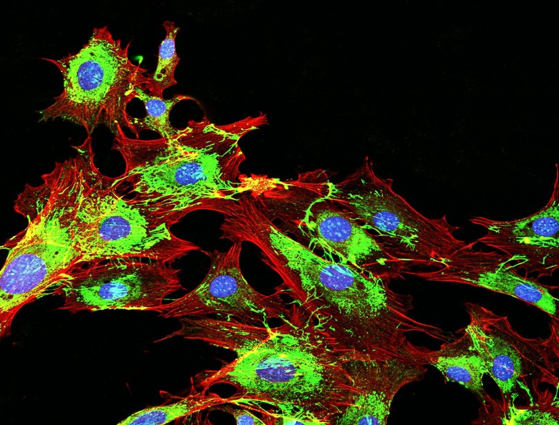 áttétes daganat, tumor, áttét, rák terjedése