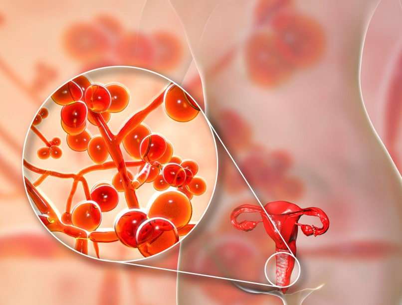 hüvelygomba, hüvelyfertőzés, nőgyógyászat, fertőzés, hüvelygomba, gombás fertőzés, hüvelyfertőzés tünetei