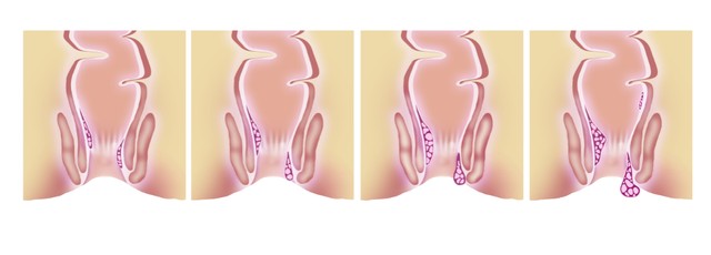 Íme az aranyér fokozatai: ismerjük fel a bajt és cselekedjünk időben!  (x)
