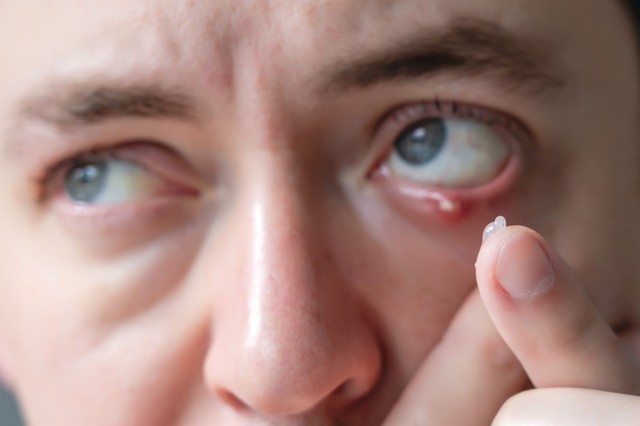 Árpa, jégárpa - tudja meg, mi a különbség a két szembetegség között