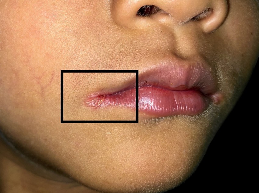 A nyálban olyan emésztést segítő enzimek találhatók, melyek sebesedést okozhatnak, ha túl hosszan érintkeznek egy-egy bőrfelülettel. 