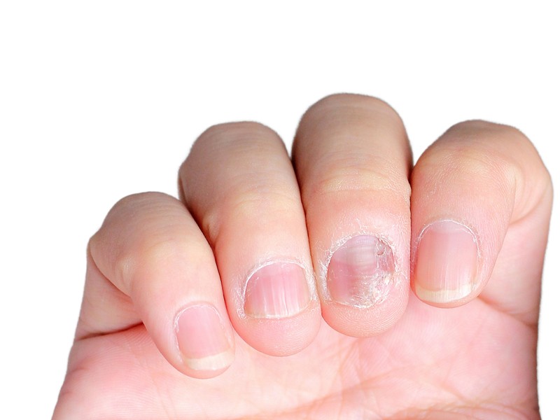 Beau-féle vonalak kialakulásának oka, tünetei és kezelése