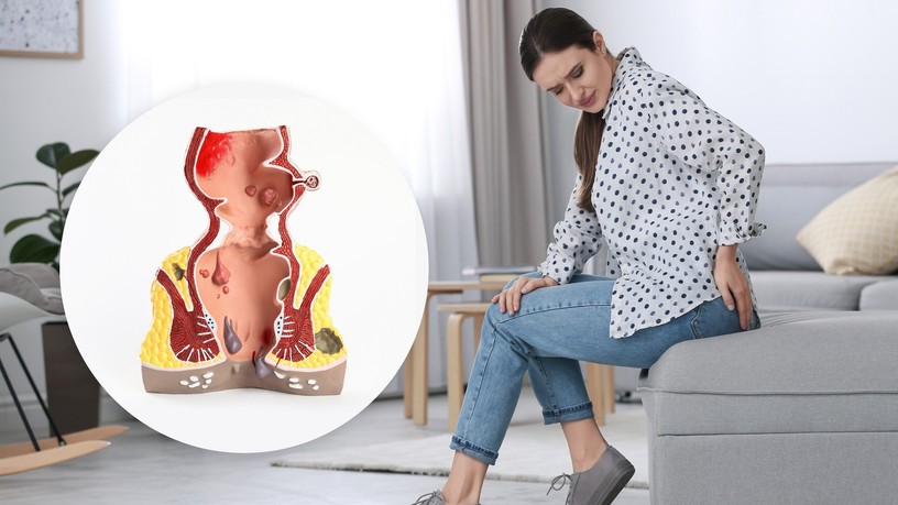 negyedik stádium előrehaladott aranyér tünete