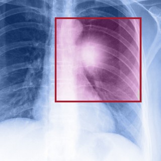 Rosszindulatú tüdődaganat: ezekkel a vizsgálatokkal mutatható ki a legjobban című cikk nyitóképe