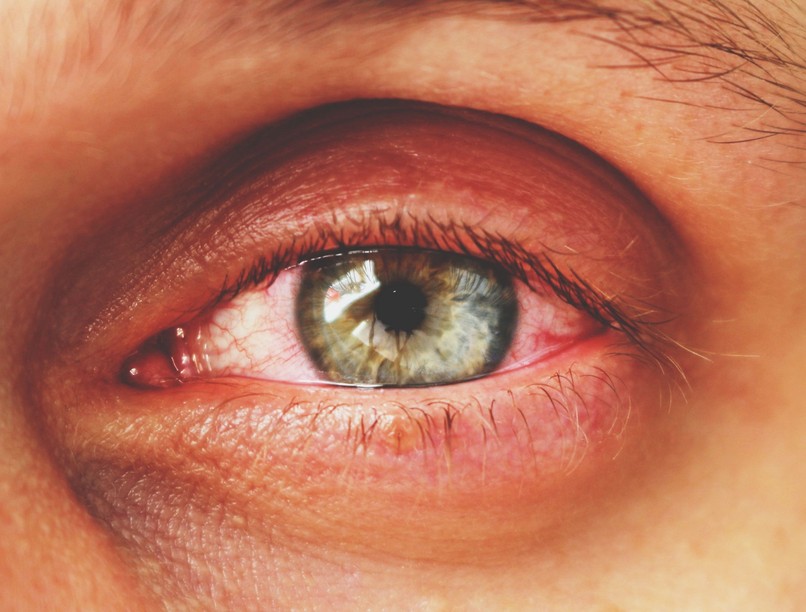 Kötőhártya-gyulladás allergia fertőzés szemgyulladás pollen