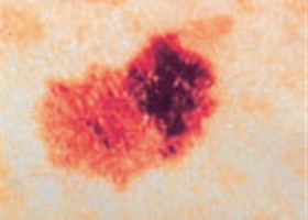 Optikai technikával a bőrrák ellen