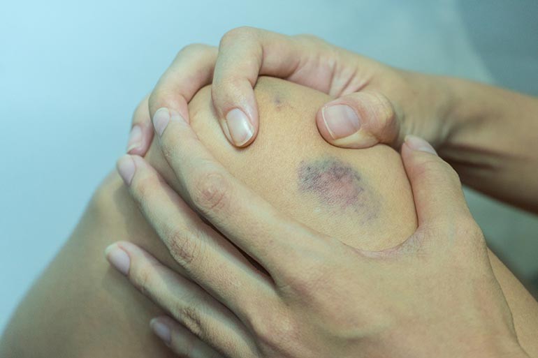 A véralvadásgátlók okozhatnak néha olyan tüneteket, amelyek megijeszthetik a beteget.